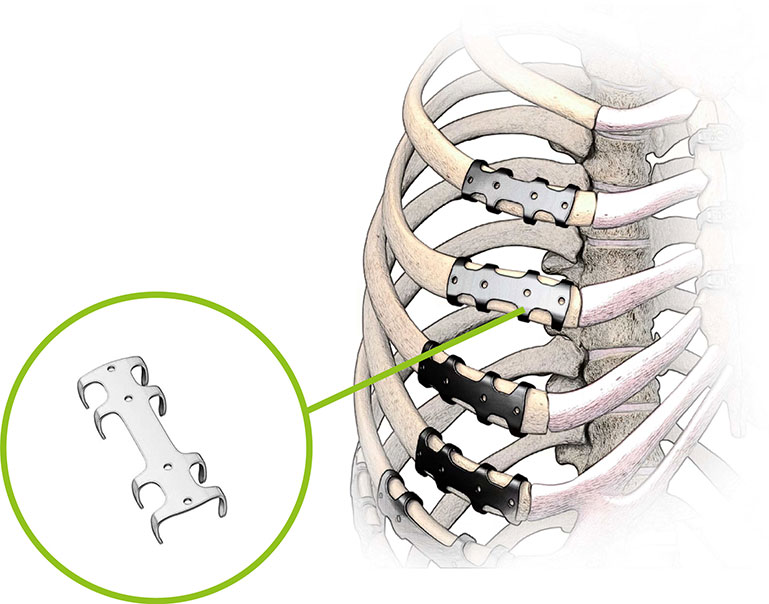 clip para fijacion costal embrace clip para fijacion costal embrace